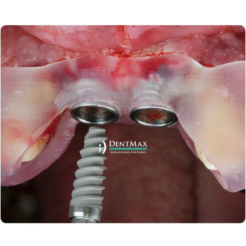 Dentmax