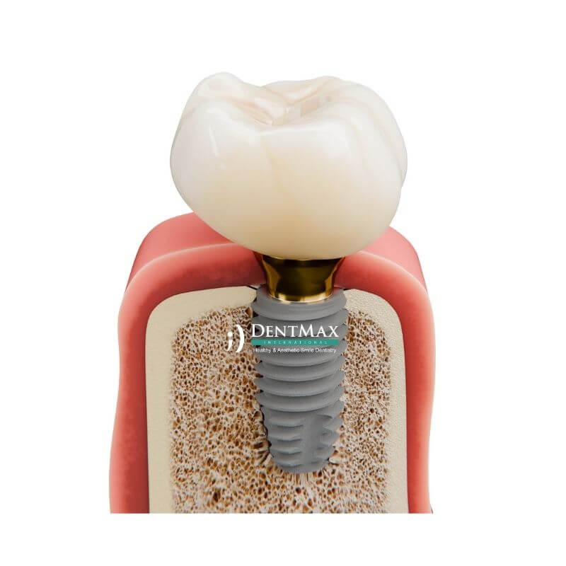 Dentmax
