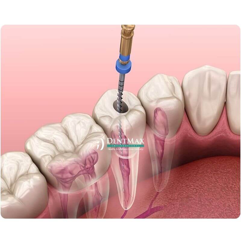 Dentmax