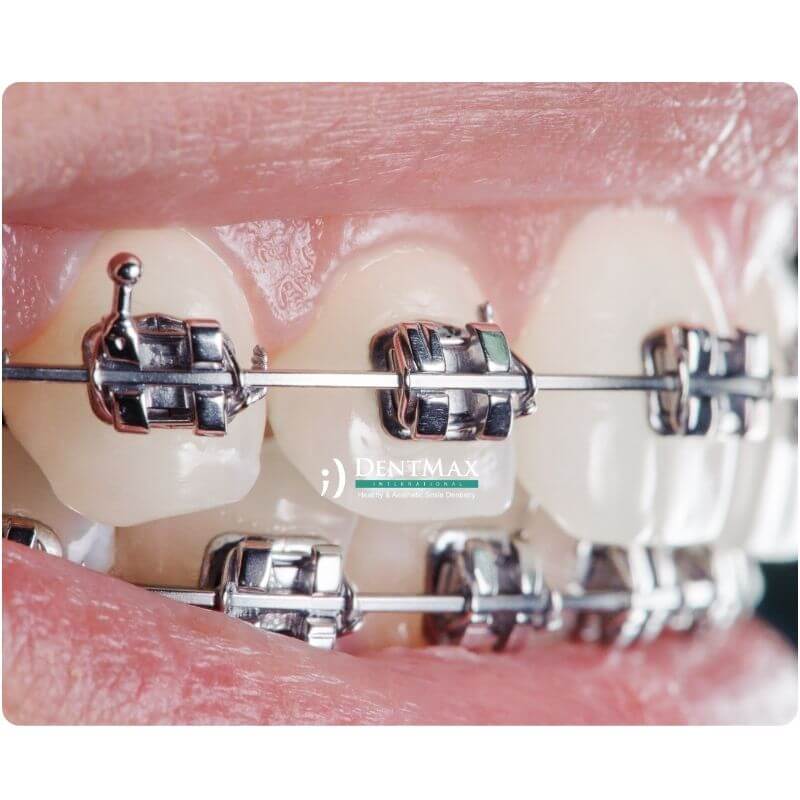 Dentmax