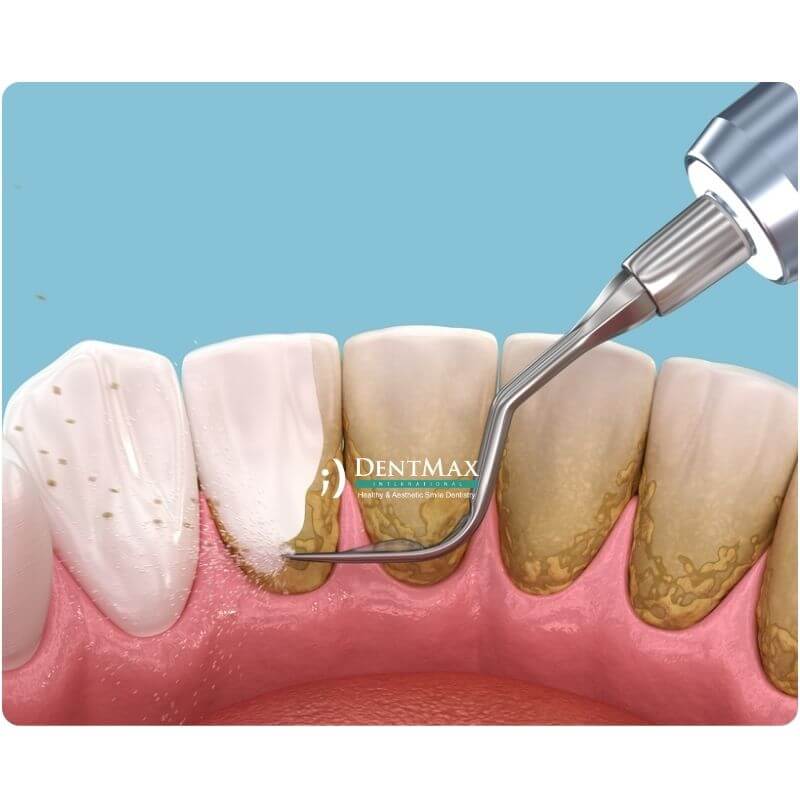 Dentmax