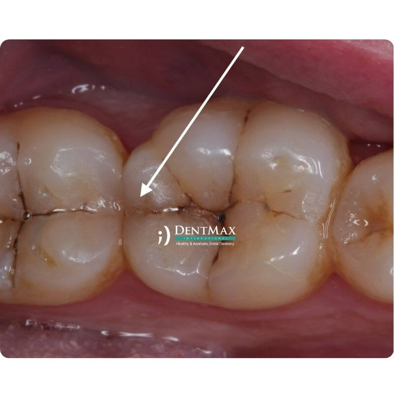 Dentmax