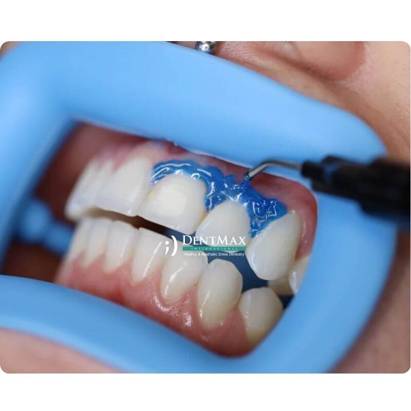Dentmax