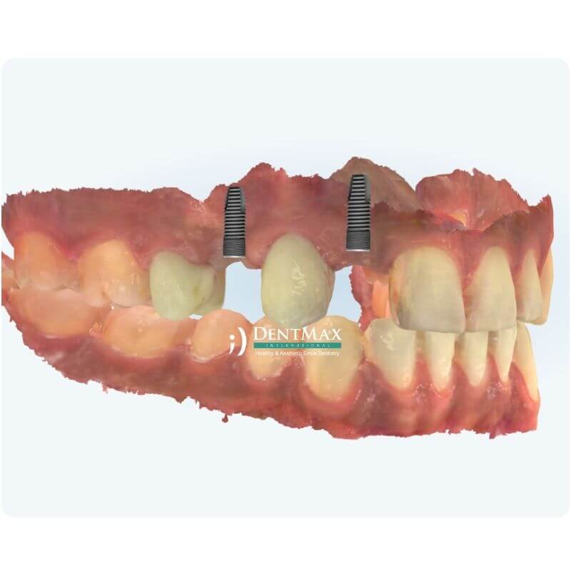 Dentmax