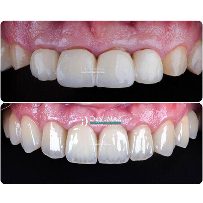 Dentmax