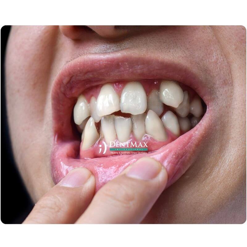 Dentmax