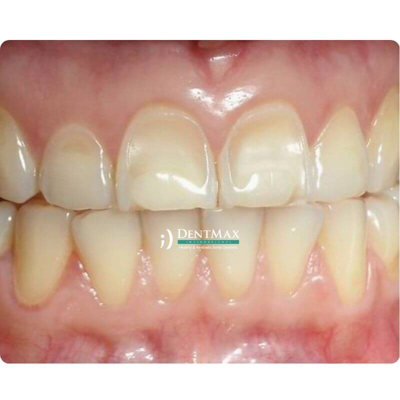 Dentmax