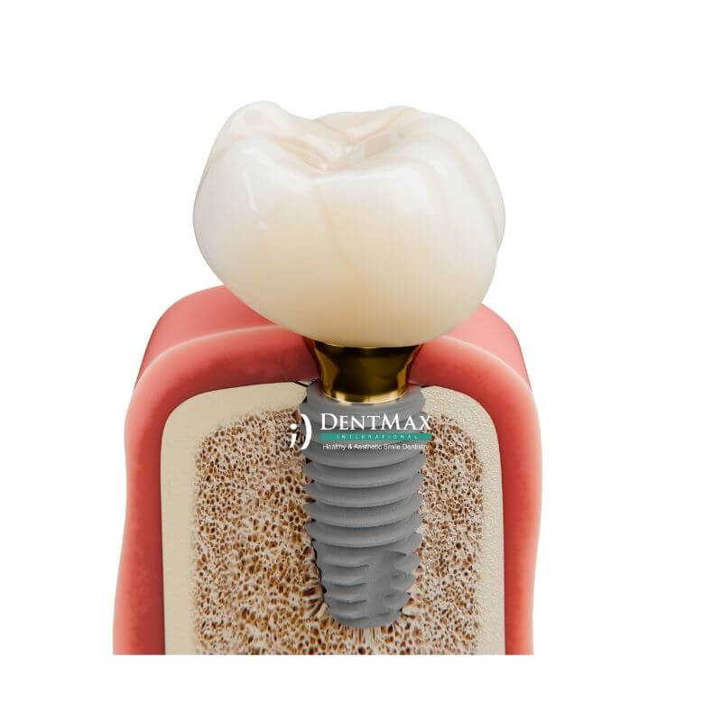 Dentmax