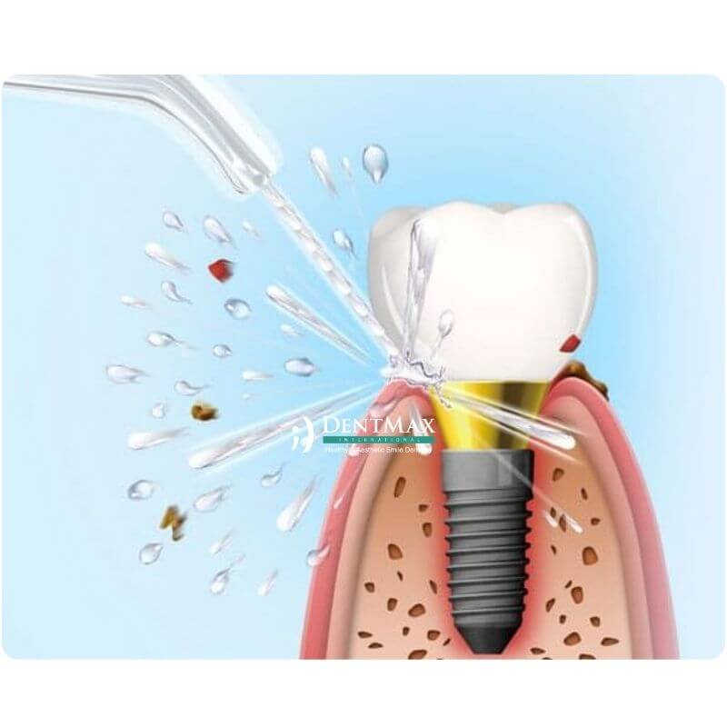 Dentmax