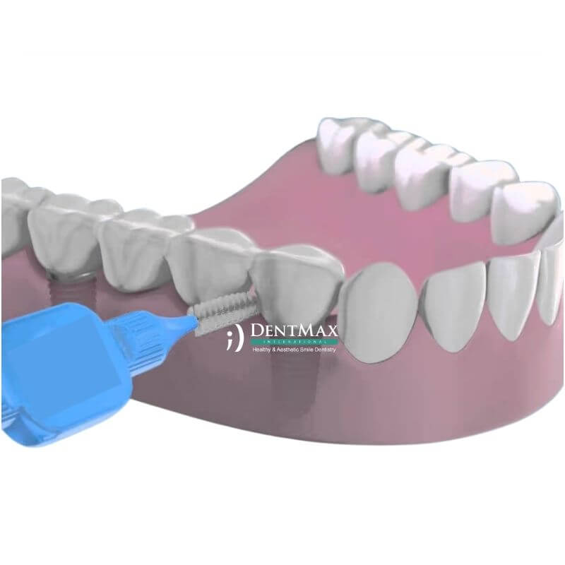 Dentmax