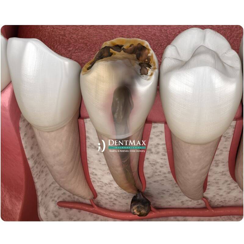 Dentmax