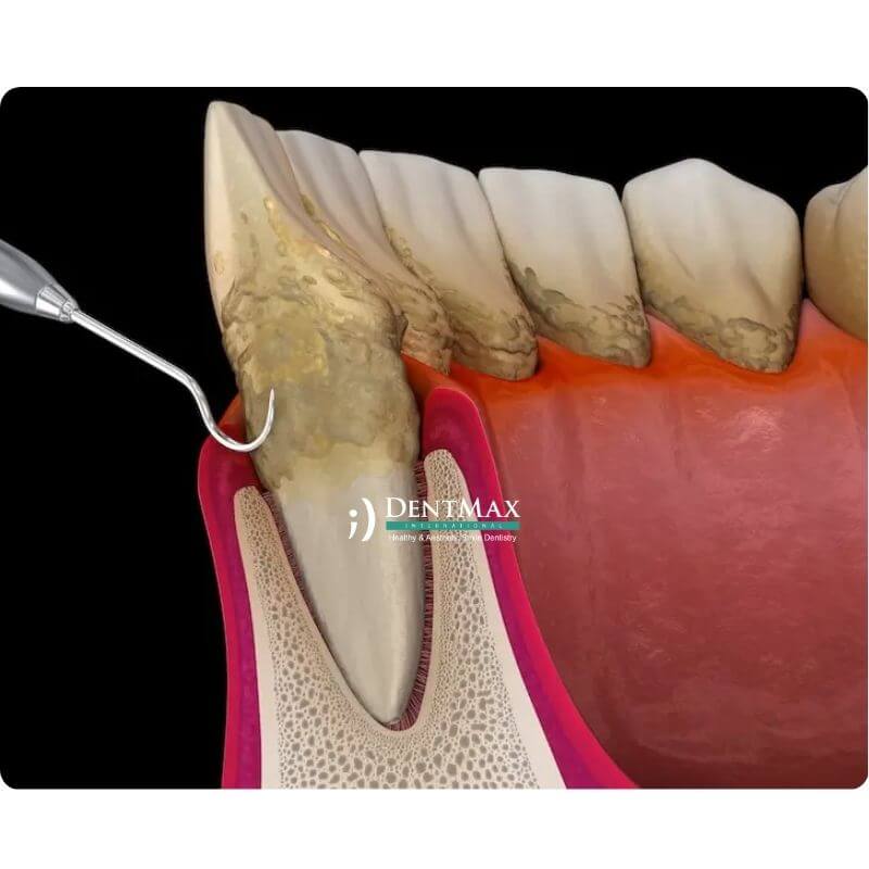 Dentmax
