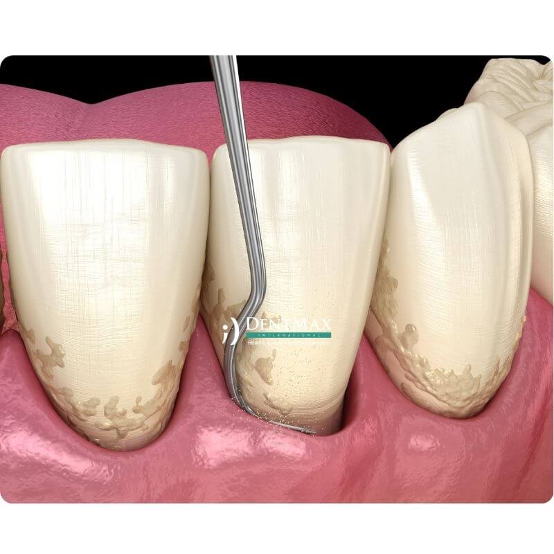 Dentmax