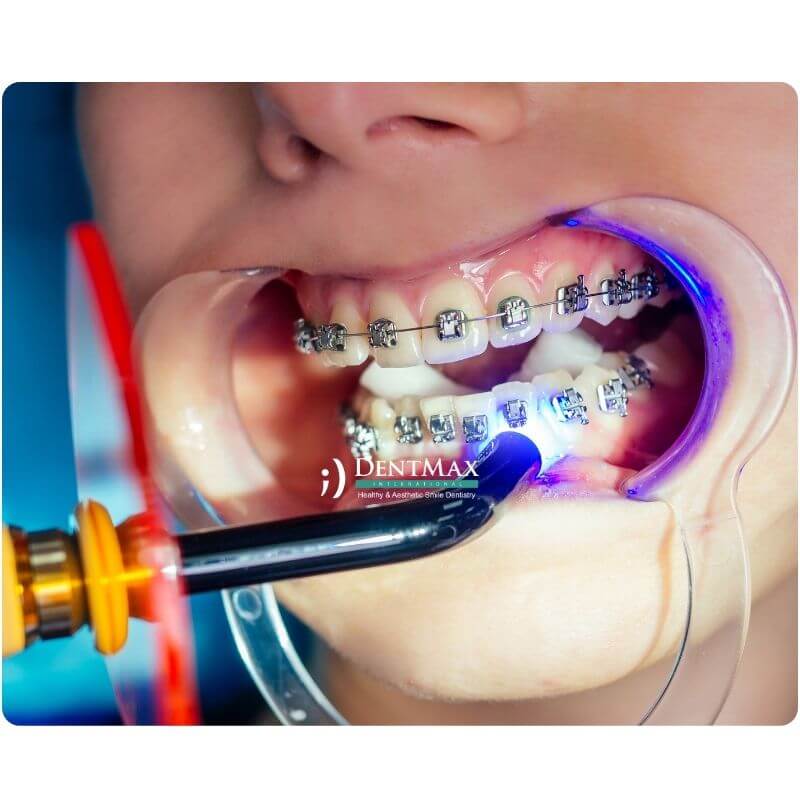 Dentmax