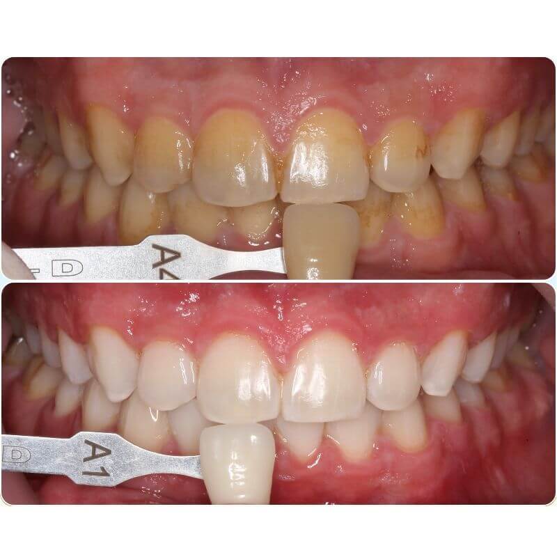 Dentmax