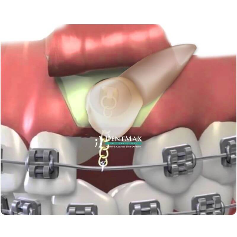 Dentmax
