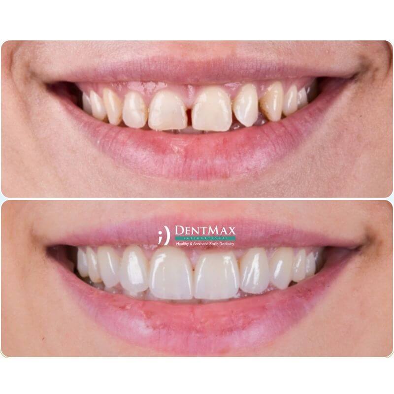 Dentmax