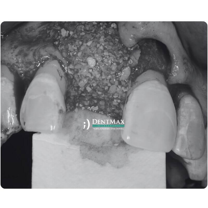 Dentmax
