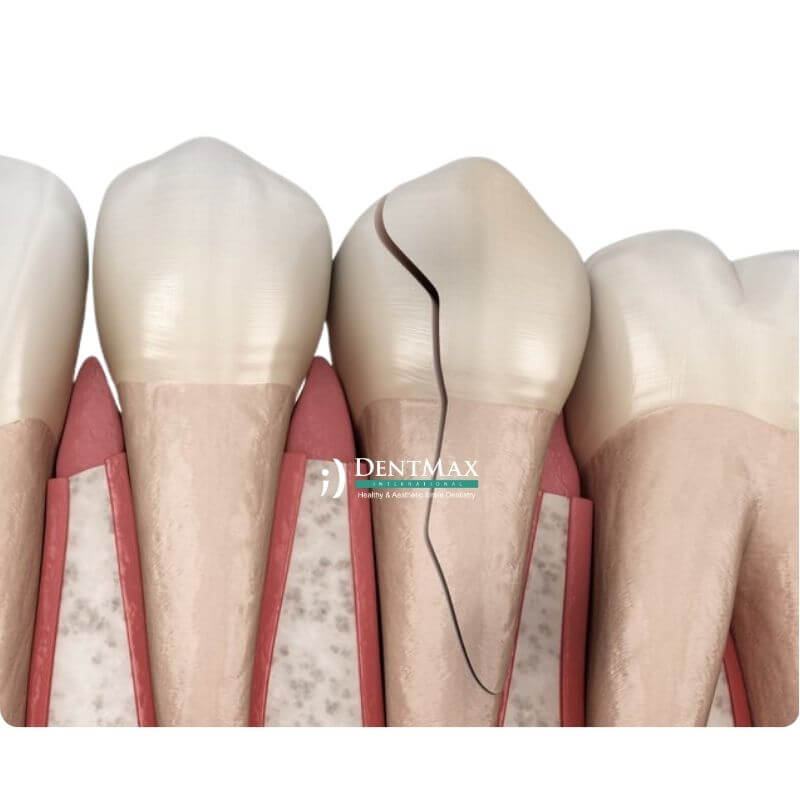 Dentmax