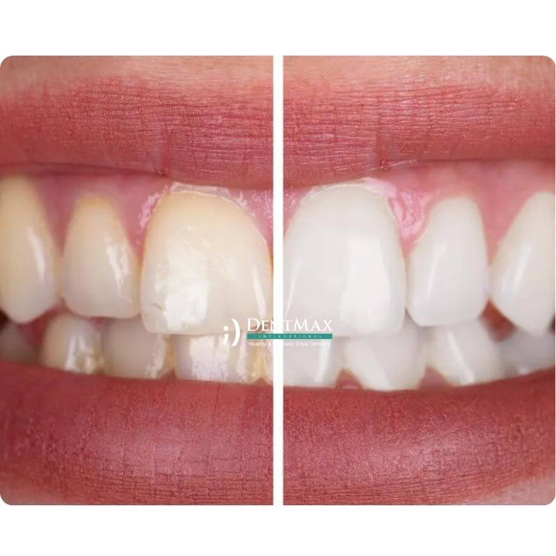 Dentmax