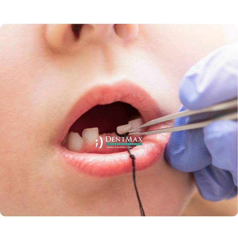 Dentmax