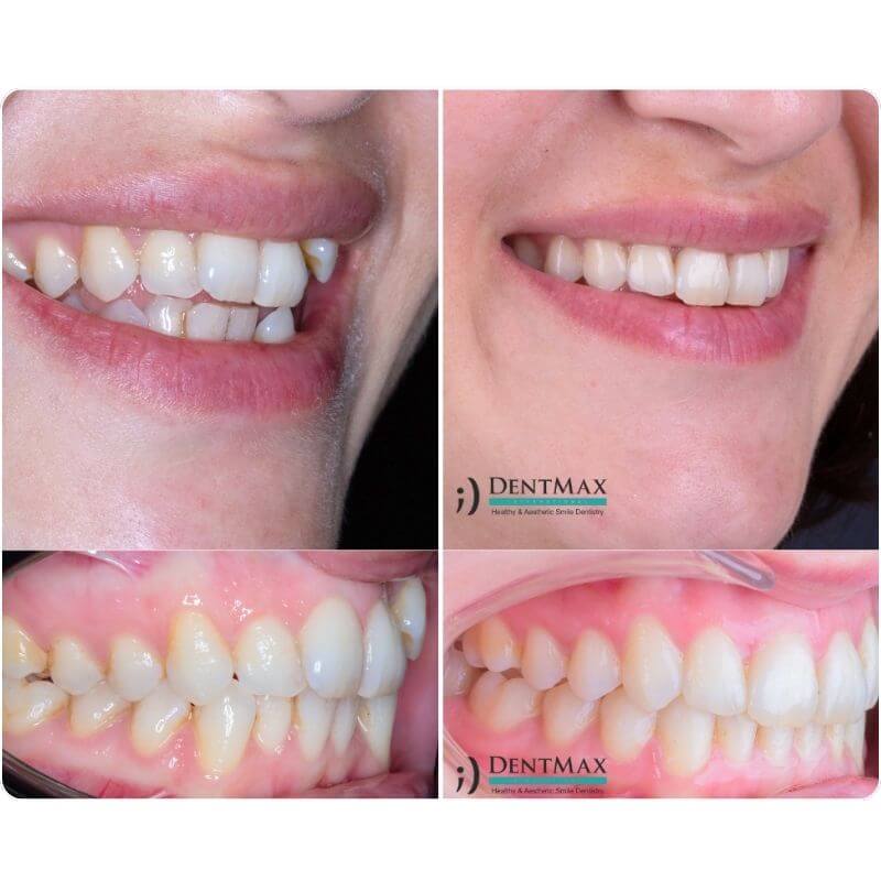 Dentmax Öne Çıkan Blog