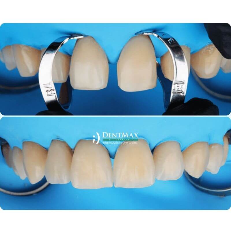 Dentmax