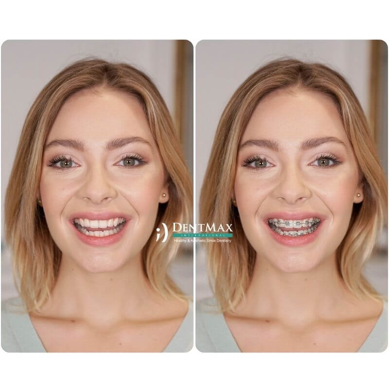 Dentmax