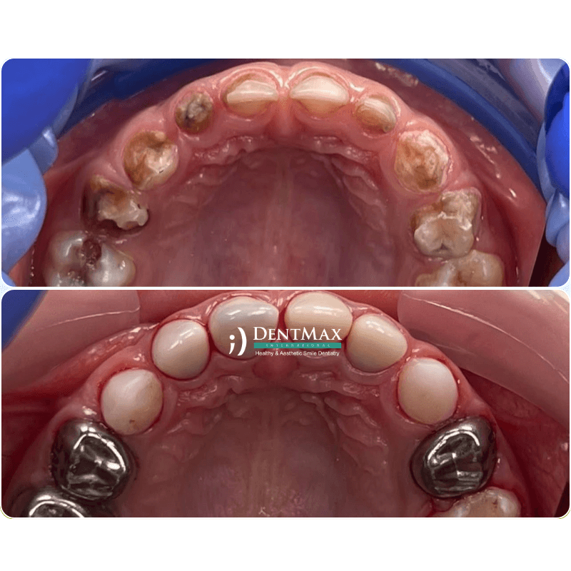 Dentmax