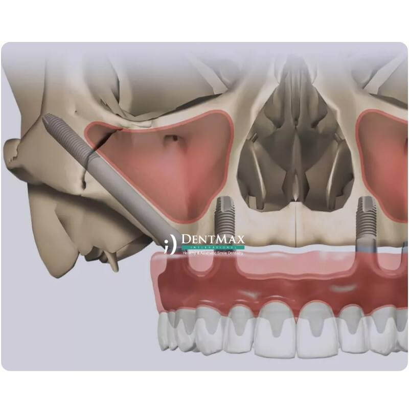 Dentmax