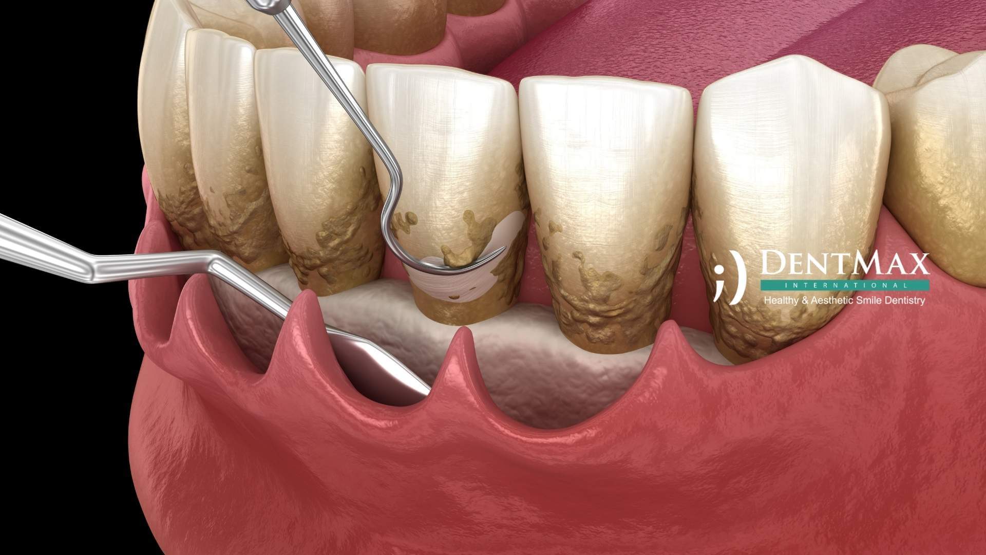 Dentmax Tedaviler