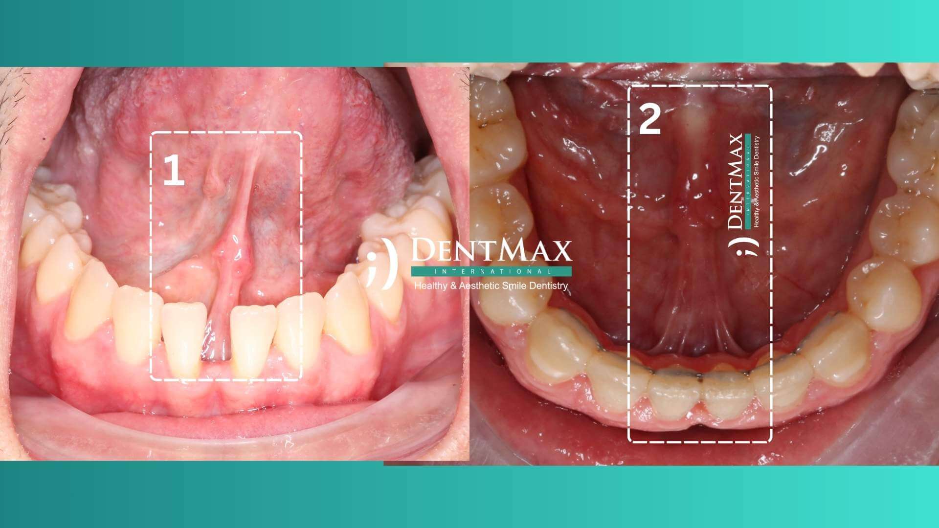 Dentmax Tedaviler