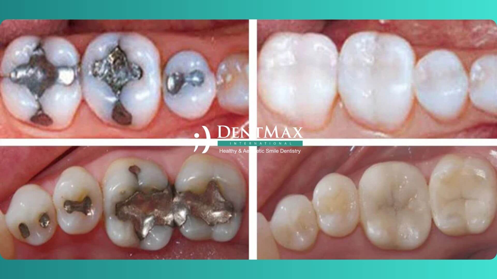 Dentmax Tedaviler