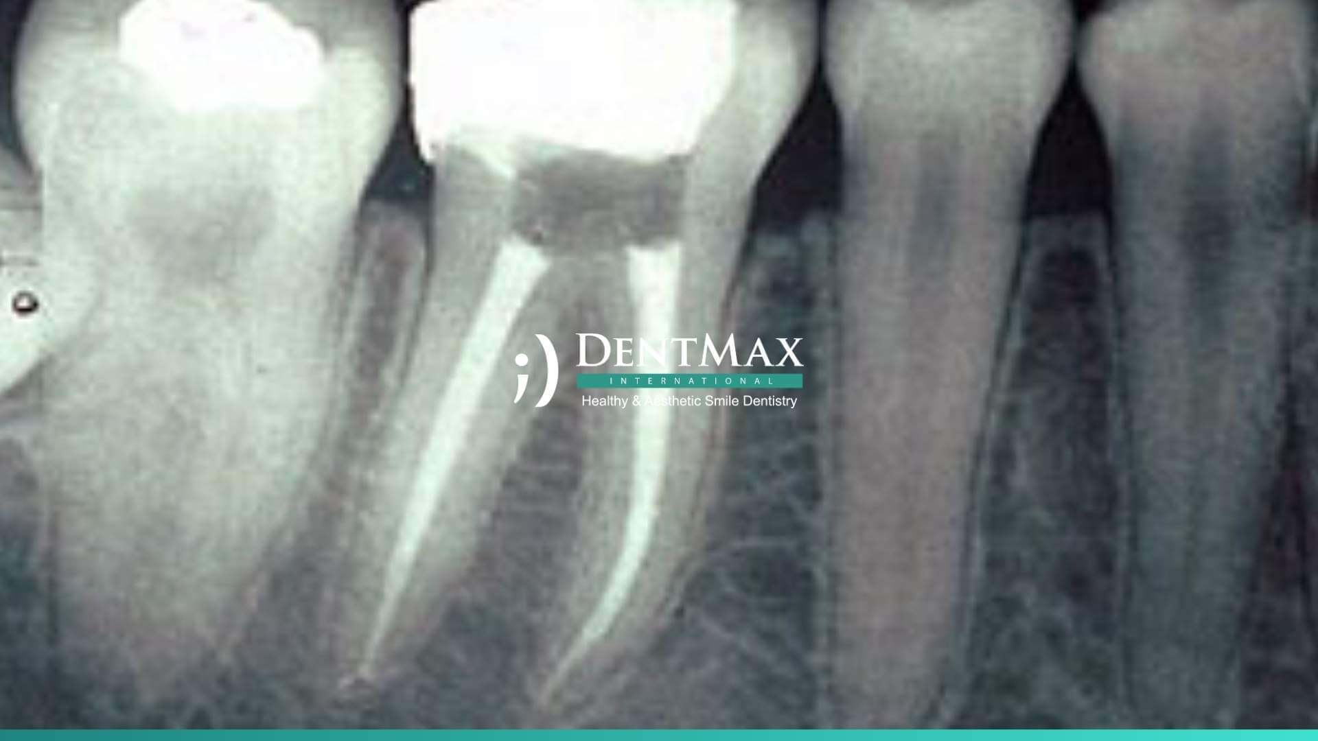 Dentmax Tedaviler