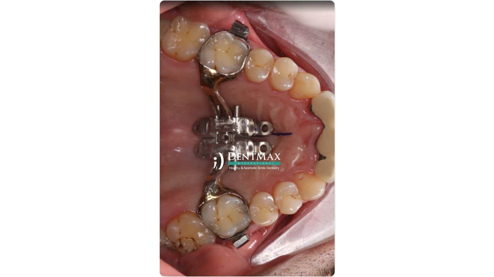 Dentmax Banner