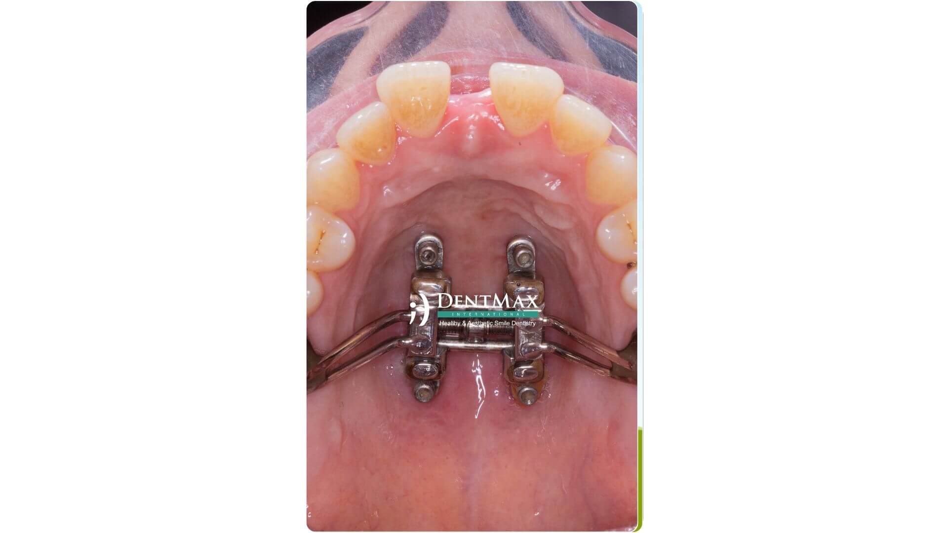 Dentmax Banner