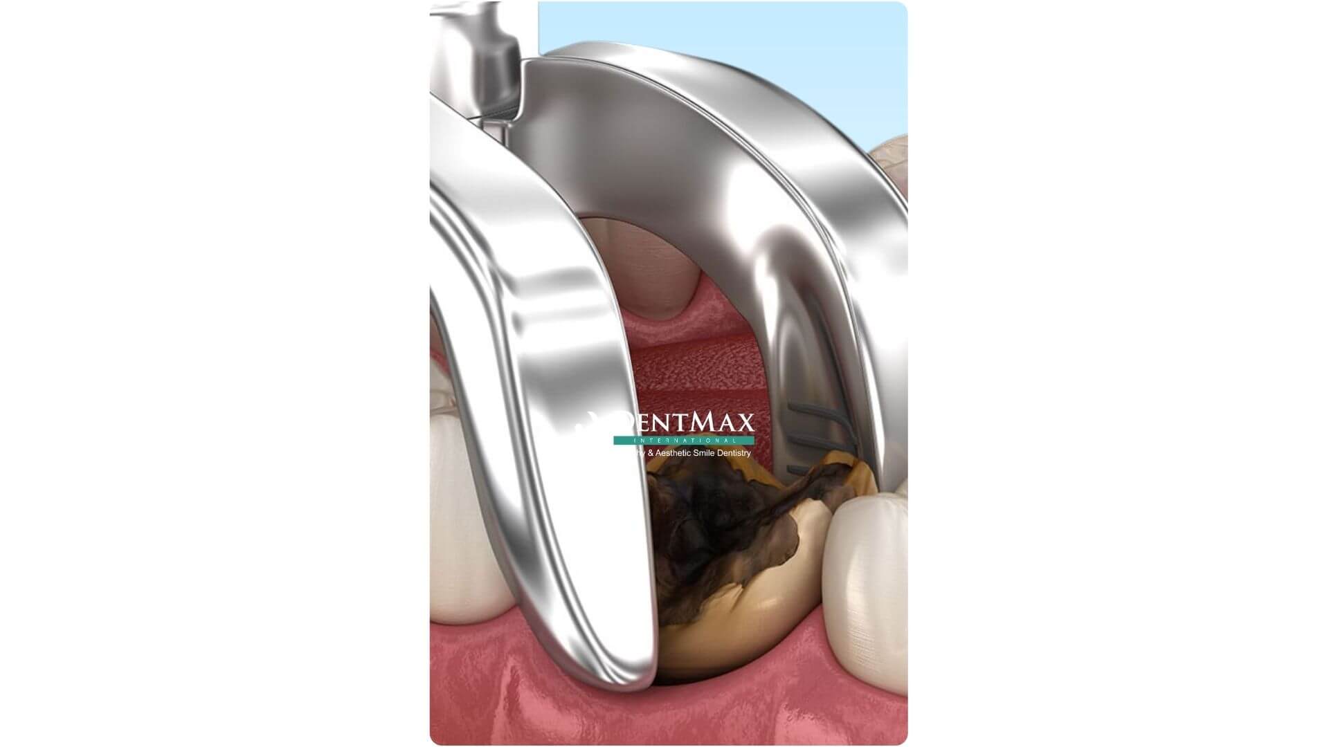 Dentmax Banner