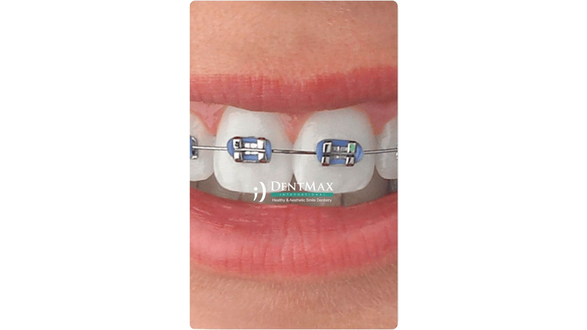 Dentmax Banner