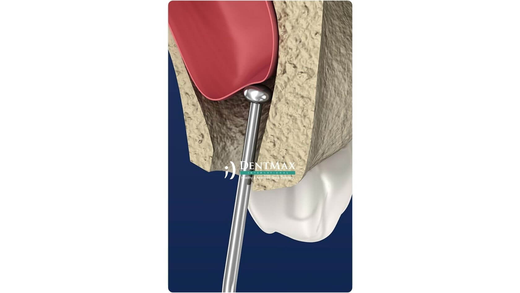 Dentmax Banner