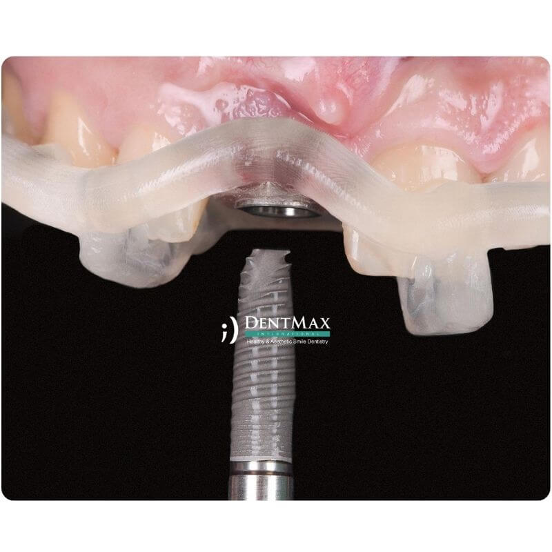 Dentmax