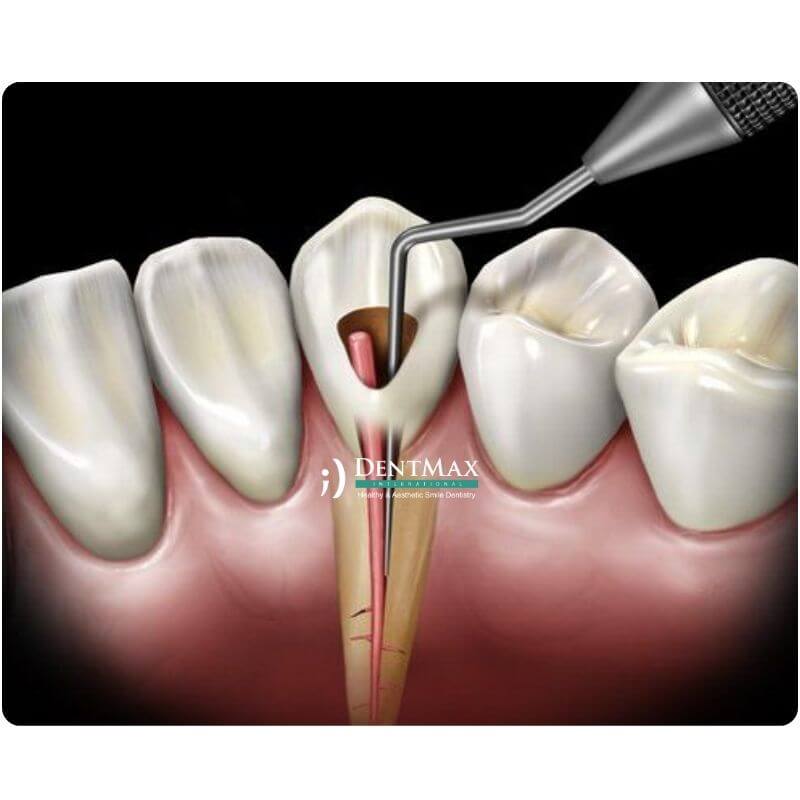 Dentmax