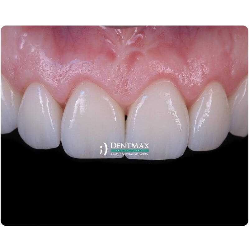 Dentmax