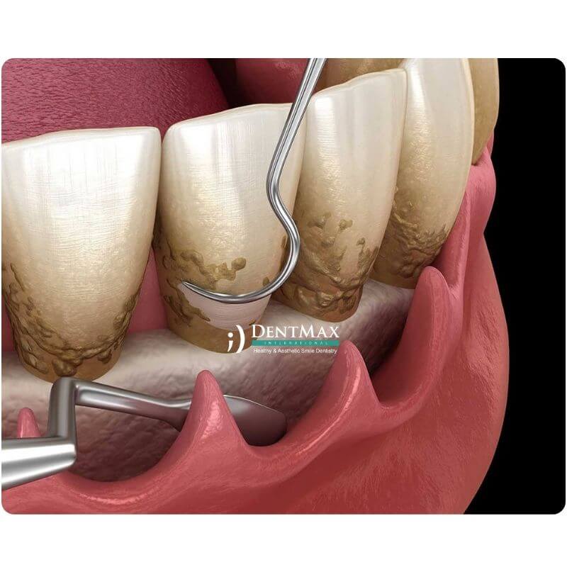 Dentmax