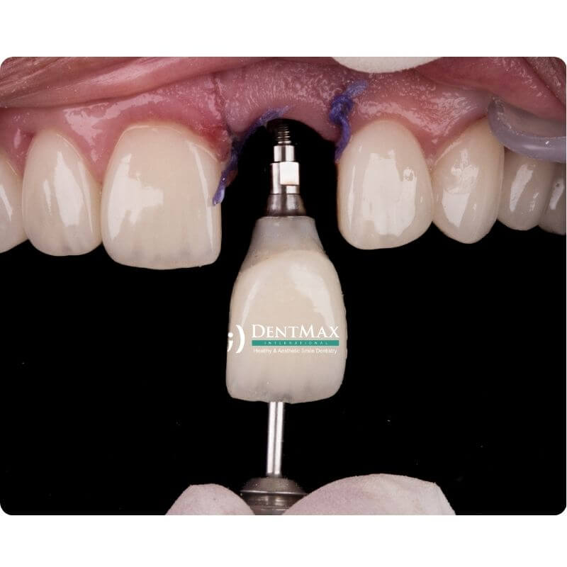 Dentmax