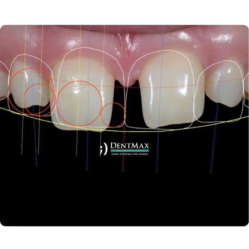 Dentmax