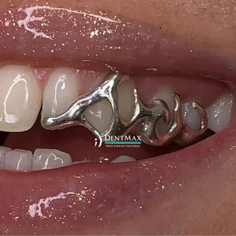 Dentmax