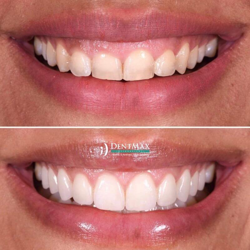 Dentmax
