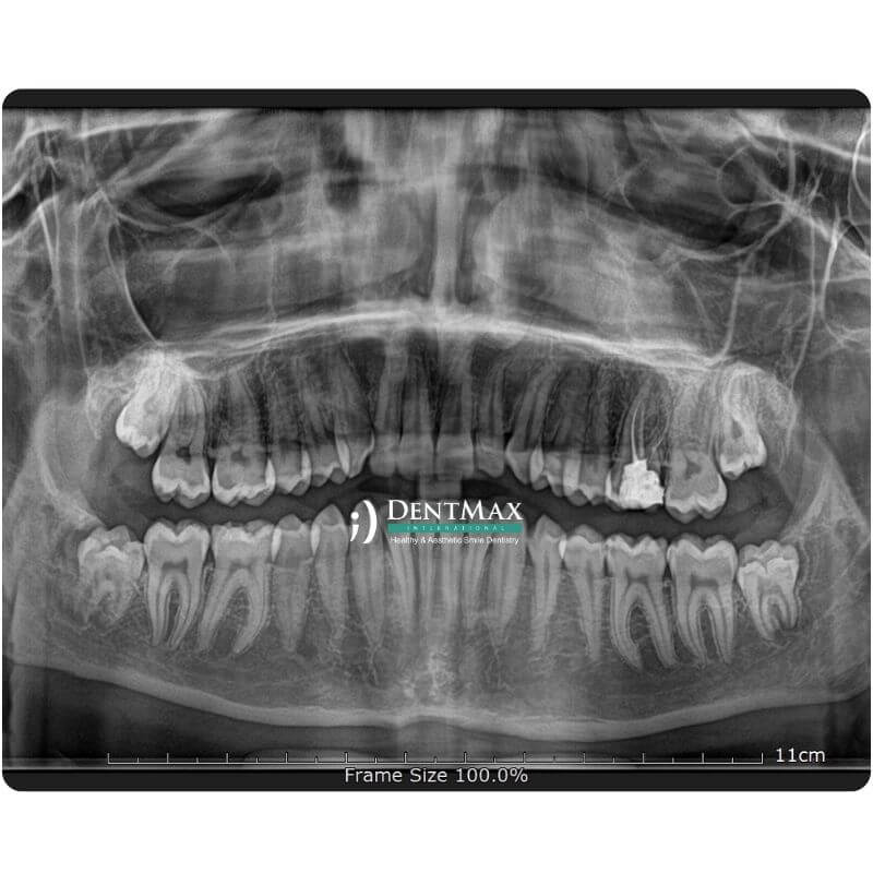 Dentmax