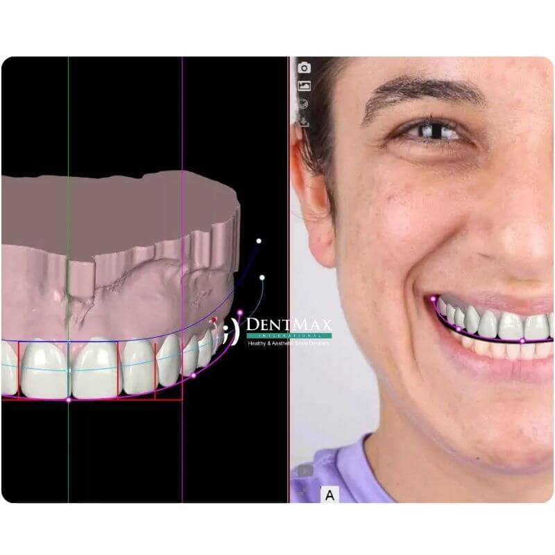 Dentmax