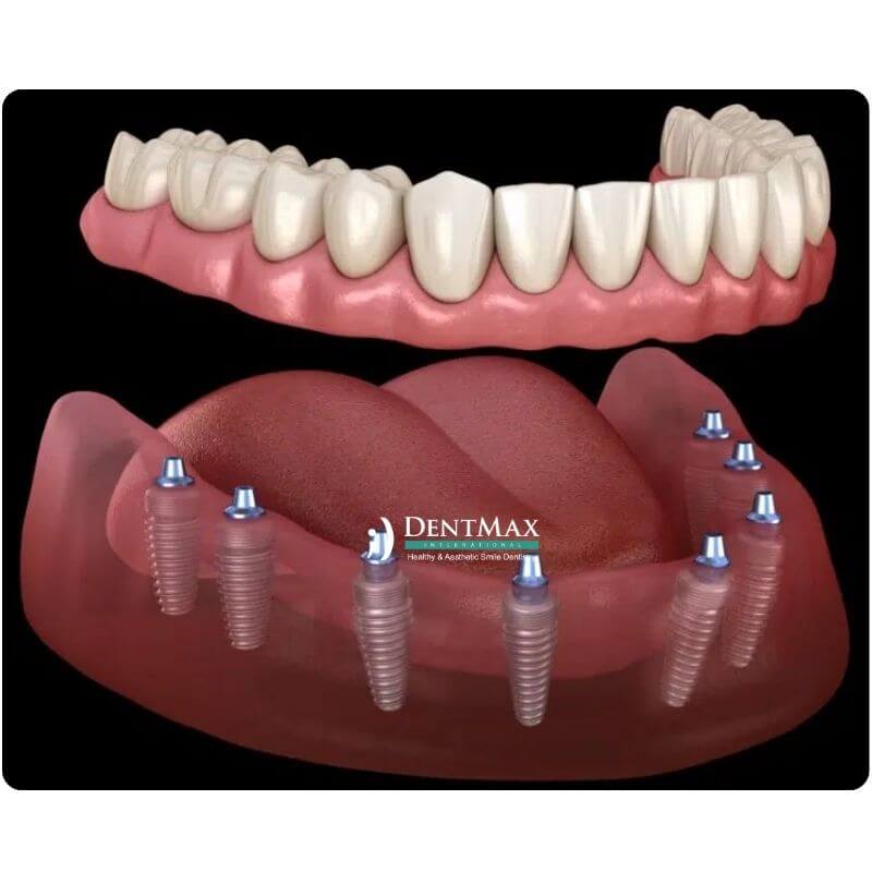 Dentmax
